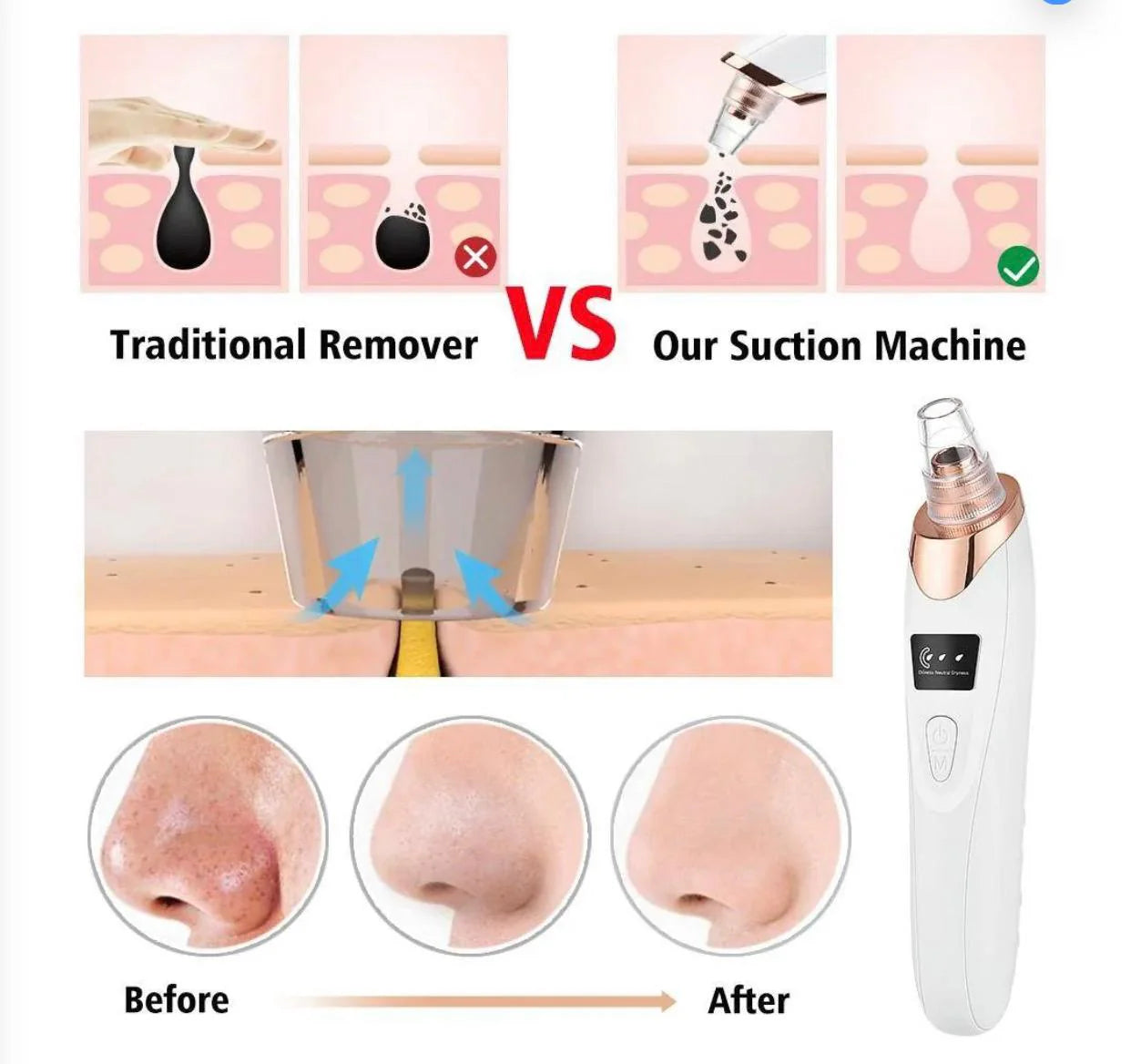 5 In 1 Blackhead Remover Machine | Deep Pore Cleaner